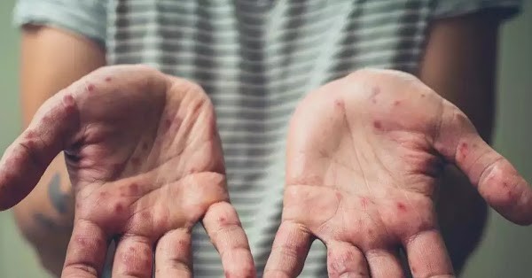 Bộ Y tế xếp bệnh đậu mùa khỉ vào nhóm B - Ảnh 1.