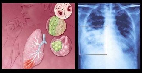 Chung tay phòng ngừa bệnh đường hô hấp do virus RSV gây ra- Ảnh 1. Chung tay phòng ngừa bệnh đường hô hấp do virus RSV gây ra- Ảnh 1.