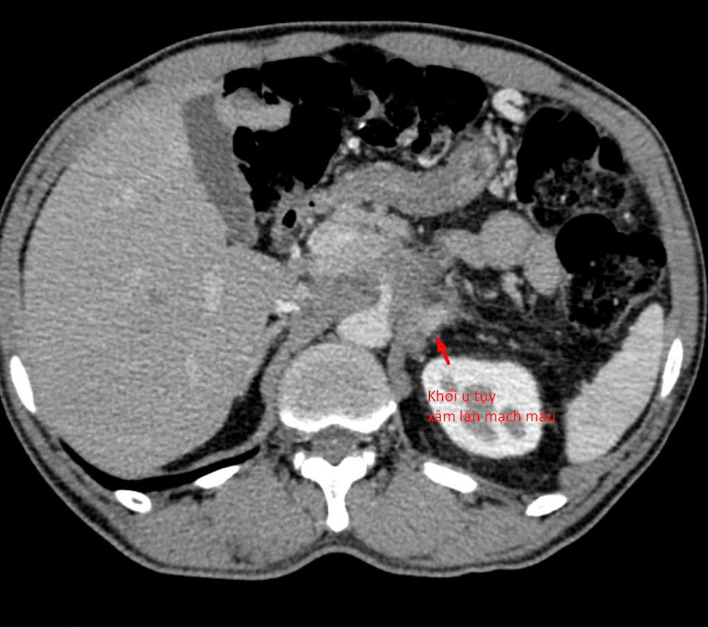Tuyệt thực 3 tuần 'bỏ đói' ung thư, bệnh nhân suýt mất cơ hội điều trị- Ảnh 1.