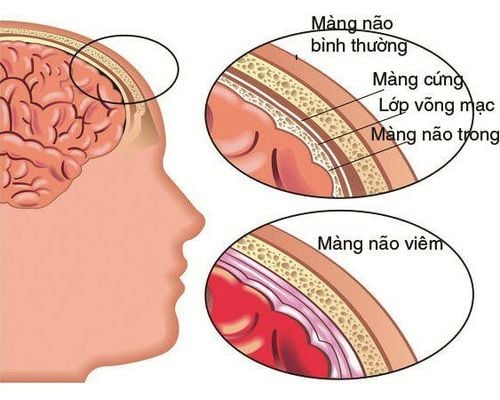 Cảnh báo số ca viêm màng não mô cầu gia tăng- Ảnh 2.