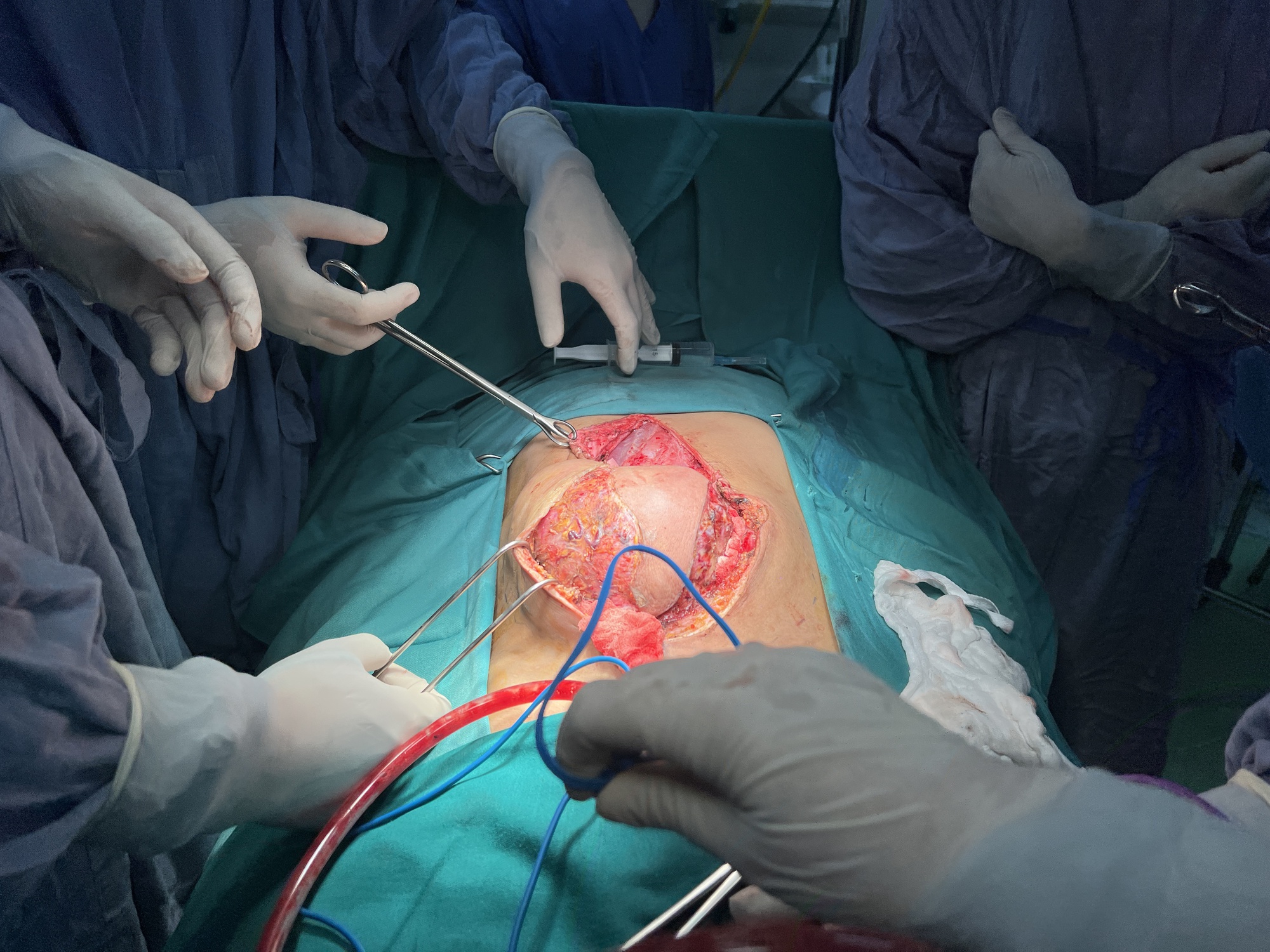 Điều trị đa mô thức cứu bệnh nhân bị khối u 3 kg di căn thành bụng- Ảnh 1.