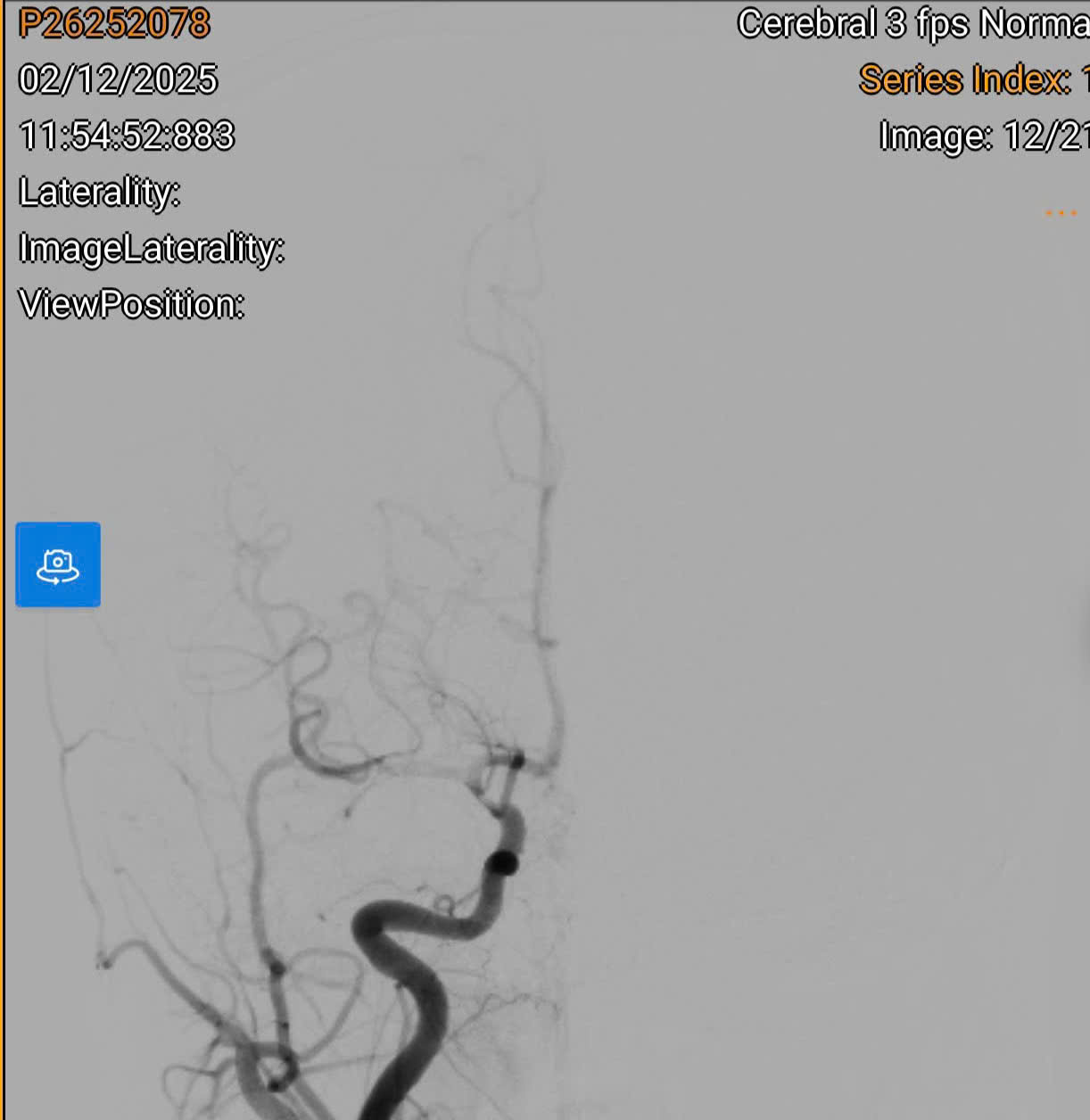 Cảnh báo đột quỵ não ở trẻ: Ca bệnh đánh thức sự chủ quan- Ảnh 2. Cảnh báo đột quỵ não ở trẻ: Ca bệnh đánh thức sự chủ quan- Ảnh 2.