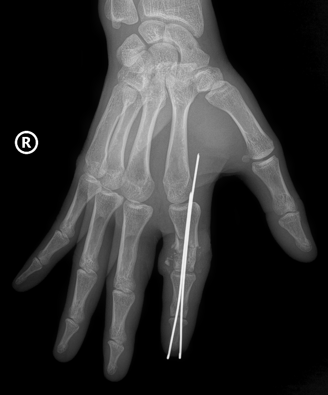 Vi phẫu thành công cứu sống ngón tay thủy thủ bị đứt rời sau 25 giờ- Ảnh 1. Vi phẫu thành công cứu sống ngón tay thủy thủ bị đứt rời sau 25 giờ- Ảnh 1.