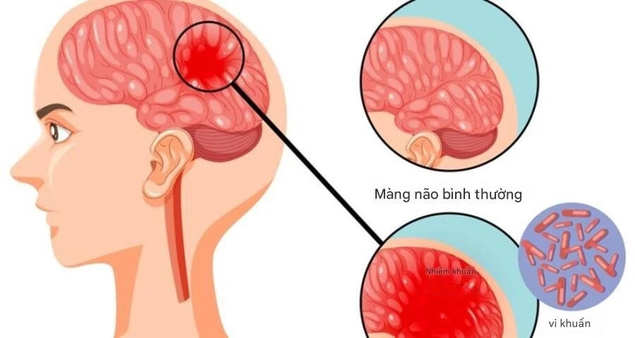 Bệnh não mô cầu có thể gây tử vong nhanh, chuyên gia cảnh báo những dấu hiệu nguy hiểm- Ảnh 1.
