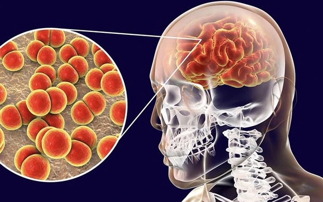 Ca bệnh do não mô cầu gia tăng