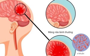 Infographics: Cách phát hiện và phòng bệnh não mô cầu - Ảnh 3.