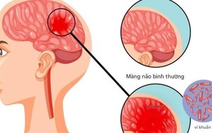 Infographics: Cách phát hiện và phòng bệnh não mô cầu - Ảnh 2.