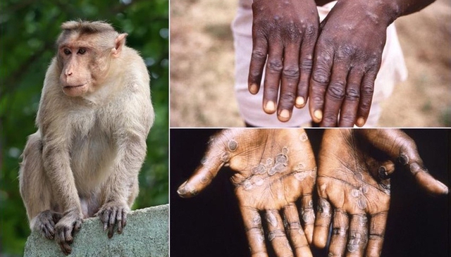 Bộ Y tế xếp đậu mùa khỉ vào bệnh truyền nhiễm nhóm B - Ảnh 1.