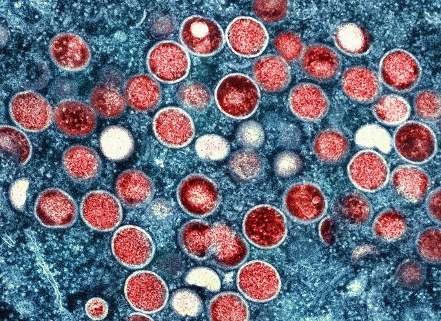 TPHCM có ca tử vong đầu tiên liên quan đến bệnh đậu mùa khỉ - Ảnh 1.