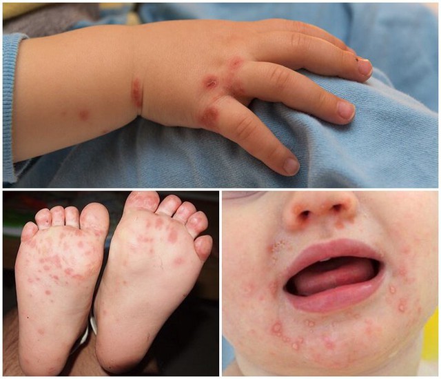 Số ca sốt xuất huyết và tay chân miệng tiếp tục gia tăng tại Hà Nội - Ảnh 1.