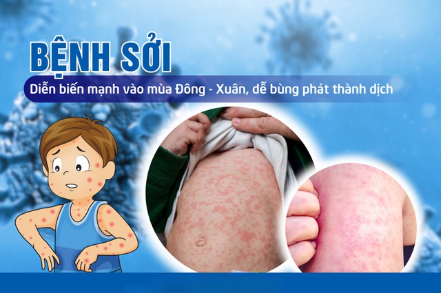 Tăng cường công tác phòng, chống bệnh sởi- Ảnh 1.