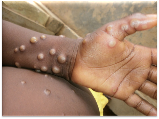 Health ministry warns of risk of monkeypox importation into Viet Nam
 - Ảnh 1.