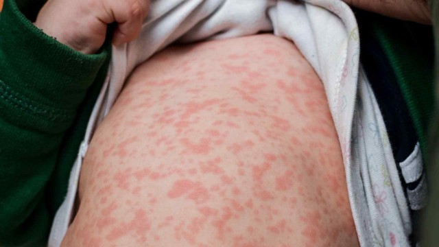 Localities urged to accelerate measles vaccine campaign- Ảnh 1.