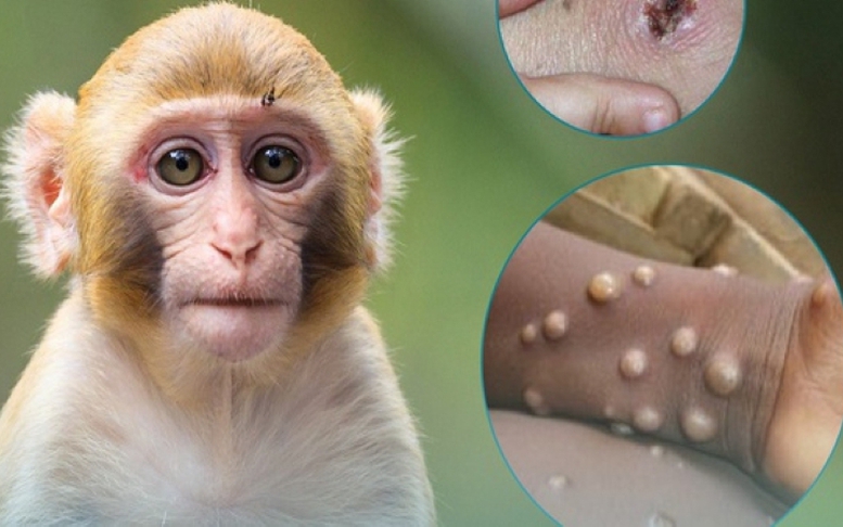 TPHCM phát hiện ca mắc đậu mùa khỉ mới