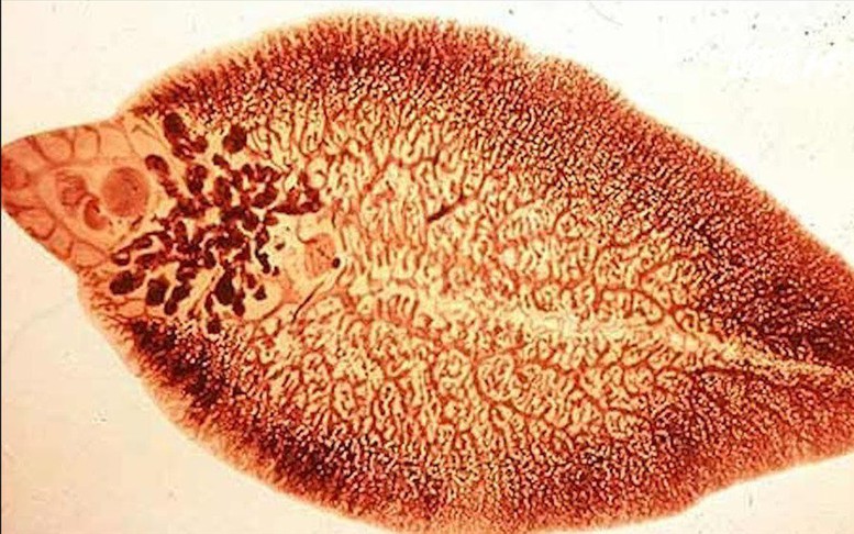 Bộ Y tế lưu ý 4 triệu chứng lâm sàng điển hình của bệnh sán lá gan