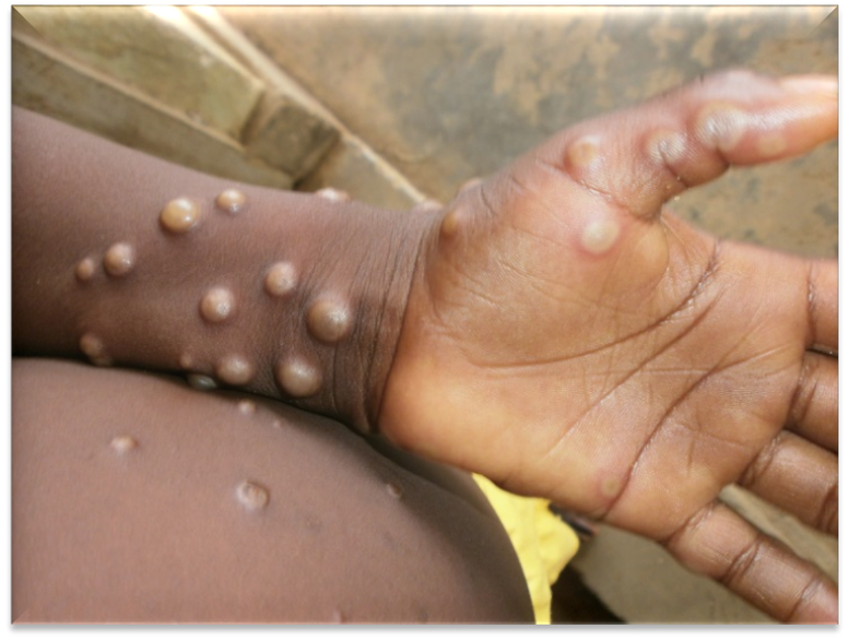 Bộ Y tế họp khẩn ứng phó dịch bệnh đậu mùa khỉ - Ảnh 2.