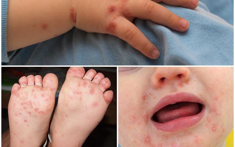 Số ca mắc sốt xuất huyết và tay chân miệng tiếp tục gia tăng tại Hà Nội