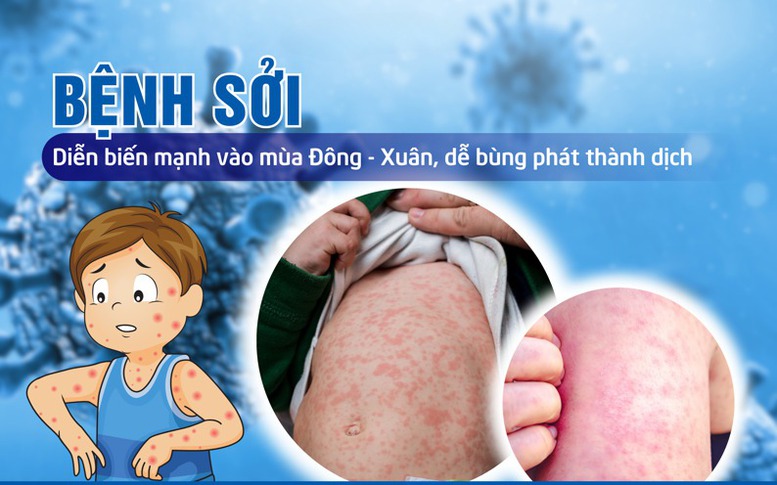 Thủ tướng yêu cầu tăng cường công tác phòng, chống bệnh sởi