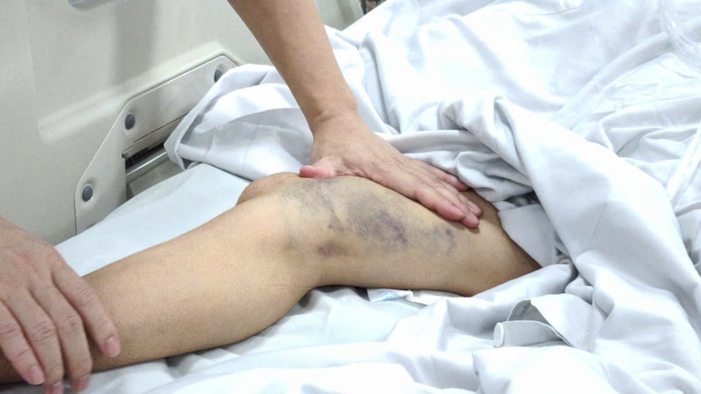 Cảnh báo gia tăng sốt xuất huyết sau mưa bão: Nhiều ca nặng nhập viện- Ảnh 2.