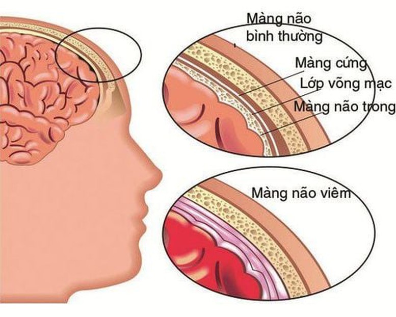 Cảnh báo số ca viêm màng não mô cầu gia tăng- Ảnh 2.