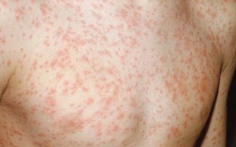 Ghi nhận 2 ca tử vong liên quan đến sởi