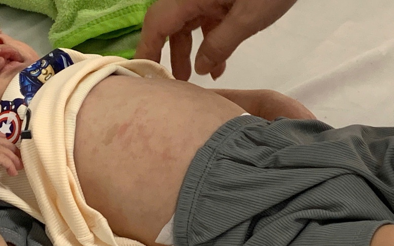 Rà soát đối tượng tiêm vaccine sởi