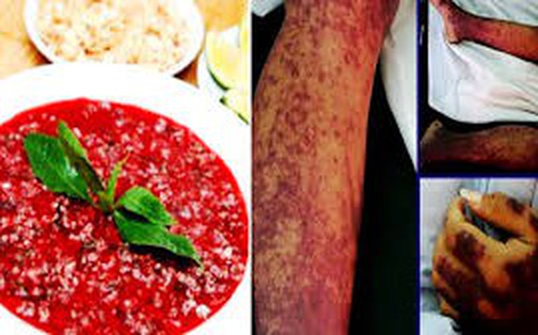Ghi nhận các ca nhiễm bệnh liên cầu lợn gia tăng
