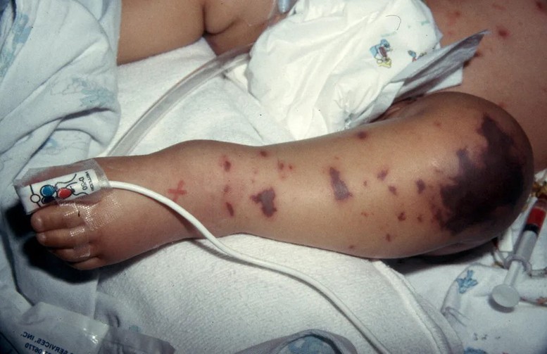 Ca bệnh do não mô cầu gia tăng- Ảnh 2. Ca bệnh do não mô cầu gia tăng- Ảnh 2.