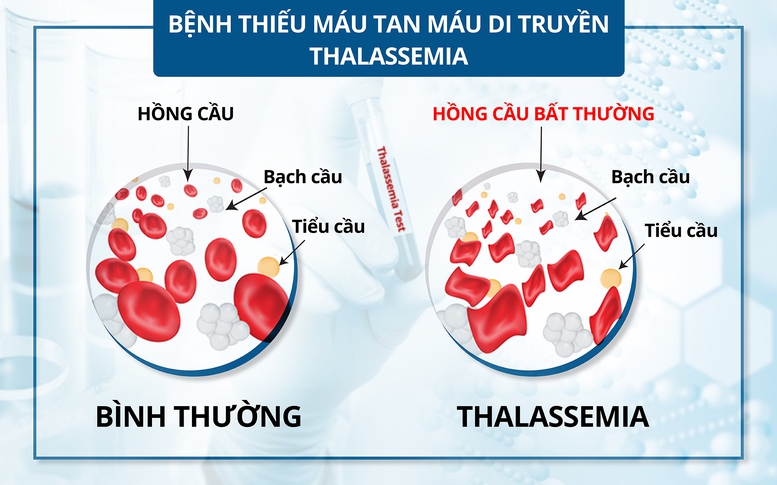 Bệnh tan máu bẩm sinh: Bệnh di truyền lặn nhưng phổ biến nhất ở Việt Nam và thế giới- Ảnh 2.