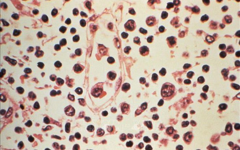 Virus Hanta: Xác nhận 6 ca nhiễm, nguy cơ lây lan toàn cầu ở mức thấp