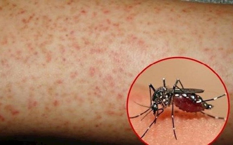 Sốt xuất huyết Dengue: Thay đổi khó lường, lan rộng và phức tạp hơn