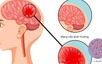 Khuyến cáo người dân chủ động phòng ngừa bệnh nhiễm trùng do não mô cầu