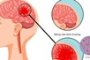 Khuyến cáo người dân chủ động phòng ngừa bệnh nhiễm trùng do não mô cầu