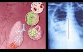 Chung tay phòng ngừa bệnh đường hô hấp do virus RSV gây ra