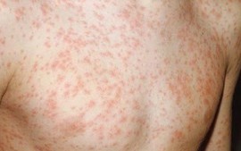 Ghi nhận 2 ca tử vong liên quan đến sởi