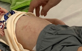 Rà soát đối tượng tiêm vaccine sởi
