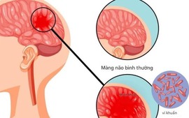 Bệnh não mô cầu có thể gây tử vong nhanh, chuyên gia cảnh báo những dấu hiệu nguy hiểm
