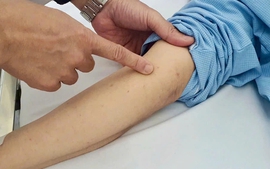 Phú Quốc ghi nhận ca nghi viêm màng não mô cầu, ngành y tế tăng cường giám sát và phòng ngừa