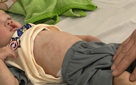 Số ca sốt xuất huyết và tay chân miệng tăng nhiều lần