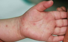 Nhiều ca nặng bệnh tay chân miệng, Bộ Y tế yêu cầu khẩn trương phòng bệnh