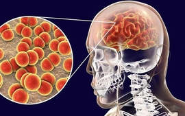 Ca bệnh do não mô cầu gia tăng