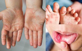 Cảnh báo bệnh tay chân miệng và sốt xuất huyết tiếp tục gia tăng, nhiều ca nặng