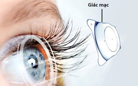 Tìm giải pháp giúp hơn 500.000 người chờ ghép giác mạc