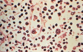 Virus Hanta: Xác nhận 6 ca nhiễm, nguy cơ lây lan toàn cầu ở mức thấp