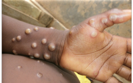 Health ministry warns of risk of monkeypox importation into Viet Nam
