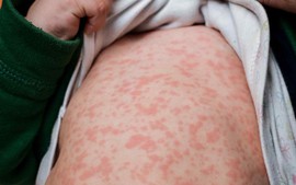 Localities urged to accelerate measles vaccine campaign