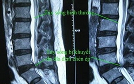 Đột phá chữa tổn thương tủy sống 