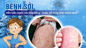 Tăng cường công tác phòng, chống bệnh sởi