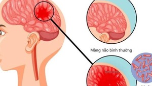 Khuyến cáo người dân chủ động phòng ngừa bệnh nhiễm trùng do não mô cầu
