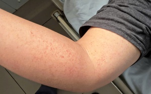 Bất kỳ ai cũng có thể mắc sốt xuất huyết và nguy cơ bệnh nặng